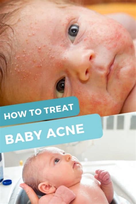 Baby Acne Treatment